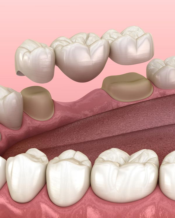 3d model of dental bridge