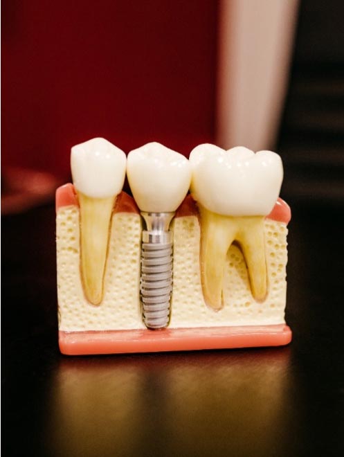 close model of dental implant