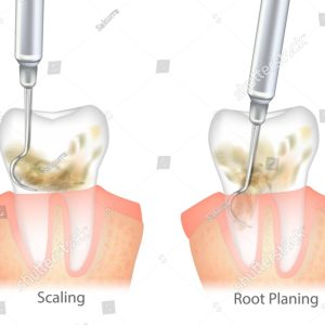 scaling and root planing