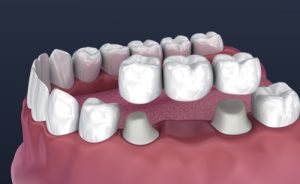 traditional dental bridge