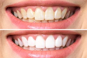 before and after teeth whitening treatment