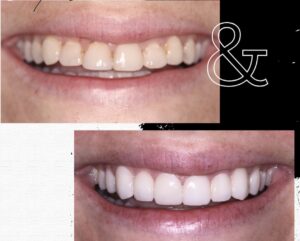 before and after zirconia veneers
