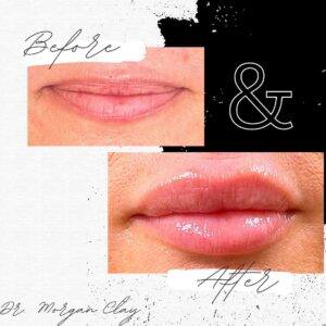 before and after lips enhancements