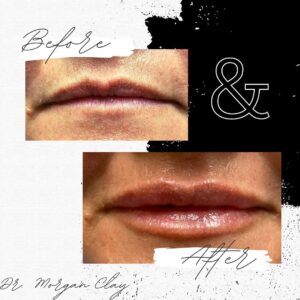 before and after lip filler