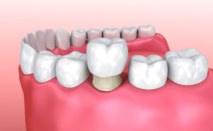 Dental,Crown,Installation,Process