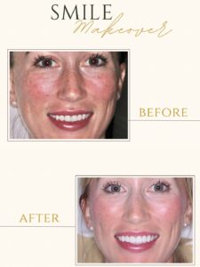 smile makeover before and after