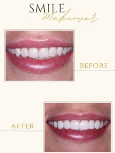 before and after emax veneers